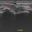 Supraspinatus tendon calcification 이미지