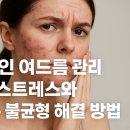 정제당약국 | 성인 여드름 관리, 스트레스와 호르몬 불균형 해결 방법
