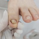 레푸스 방이역점 | 송파 무좀발톱 케어잘하는곳 레푸스 방이역점에서