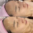 위례피부관리 송파위례점 올가드림뷰티 모공청소 모공디톡스관리