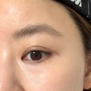 준메디칼스킨케어 | 쌍문동 기미잡티케어 추천, 이음메디컬스킨 관리 후기