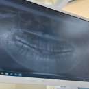 더연세퍼스트치과병원 | [세브란스] 세브란스 연세대학교 치과대학병원 사랑니 발치 후기