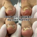 효자역 | 효자역 파고드는 내성발톱은 네일은에서 해결하세요.