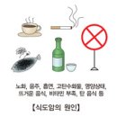 식도암 이미지