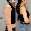 팔복장 | 대구 팔 지방흡입 두달차 후기 및 병원 후관리 정보 공유!