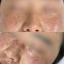 456 | 인천 구월동 잡티제거 미작뷰티 인천점 _ 잡티제거 1회차 후기