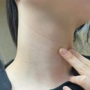 천안 코코마쥬 실면도 편평사마귀 제거 내돈내산 후기