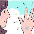 굳은살