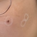 메이퓨어의원 산본점 | 더워지기전에 점 빼기