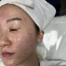 고은결헤어 | 강동구에스테틱 고은결에스테틱 트러블관리 꼼꼼한 압출 후기