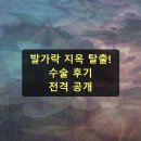 두발로슈즈마트 | 발가락 수술 사례 회복까지의 실제 후기