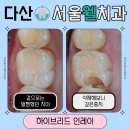 웰치과의원 | [남양주다산/서울웰치과] 겉으로 멀쩡했는데 깊은 충치?! 하이브리드 인레이로 자연치 보존