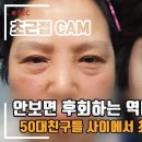 [4K] 하안검재수술로 예쁜 애굣살까지 만들 수 있다？？중년성형 케이스 이미지