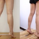 K-body | $37. 하체성형의 미래: 종아리·허벅지·엉덩이를 아우르는 AI 통합 플랫폼