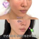 수분옆들 | 별내피부관리 온날뷰티 에스테틱에서 만년홍당무인간 수분진정관리후기