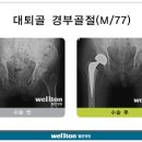 [고관절인공관절] 고관절 골절, 초기에 관리 필요 이미지