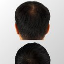 꼼꼼건강 | 천안두피건강 꼼꼼탈모커버와 함께한 일상 관리 후기