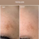 플라리온 | 전주 효자동 기미.잡티 관리 1회만에 이렇게? 플라리온 관리 리얼 후기!