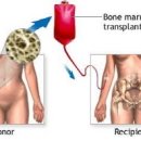 조혈모세포이식의 역사, 방법, 그리고 면역학 이미지