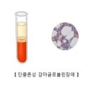 단클론성 감마글로불린장애 (Monoclonal gammopathy of undetermined significance 이미지