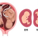 임신 때 태아가 거꾸로 있는 '역아'현상.. 해결기도문.. 이미지
