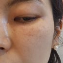 압구정 루*의원 추가 후기 (1개월 차/ 사진 추가)