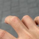 미앤뉴피부과의원 | 손가락 사마귀 냉동치료 2탄 -하대동 미앤뉴 피부과