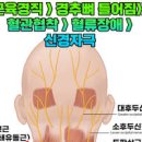 뒷골이 땡기는 이유 오른쪽 왼쪽 뒷골 통증 땡김 머리 뒤통수 두통 이미지