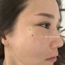 세포 | 눈밑꺼짐+앞볼 줄기세포 더마셀 내돈내산 부작용,후기