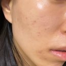 붉은천 | 홍대피부과 피코토닝 여드름 붉은 흉터 후기