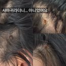 에스와이바른피부과의원 | 머리 혹 제거 후기｜범계에선 사마귀라더니… 동네 피부과에서 신경섬유종으로 바로 제거 (+보험 됨)