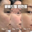 검단 아라동 여름철 기미 피부관리, 비비드엘 인천점에서 기미 잡티 개선하고 피부톤 맑아진 상세후기