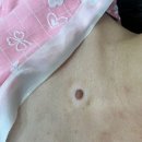 아이앤힐성형외과의원 | 하남 미사 돌출점, 큰점 제거 수술 : 후기 및 가격 정보