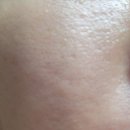 동안 | 모공관리 시술 비쏠르 동안크림 사용 후기