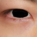 대림외과의원 | 안검하수수술비용, 5000례 집도한 성형안과 전문의가 말하는 '가격보다 중요한 것'