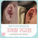 태종의료재단지점 | 백일아기 귀교정, 신생아 귀교정 골든타임 놓쳤는데 괜찮을까? 3개월귀교정 후기