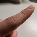 화상 물집과 응급처치 방법, 연고는 어떤 것 사용?
