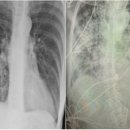 흡연자 폐보다 심각한 코로나19 환자의 폐 이미지