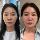 신논현피부과 울써마지 내돈내산 후기 가져왔어요! 얼태기 타파 리프팅 레이저 TOP of TOP