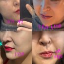 라렌의원 | 내돈주고, 아름닥터 팔자 필러 후기 (가격,위치,한달차