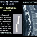 강직성척추염(Ankylosing Spondylitis) 이미지