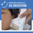 구미 리니어지리프팅과 팔자주름필러 통증 시간 효과