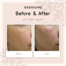 내돈내산 기미 잡티 I2PL 솔직후기 + 시술 후 재생크림, 선크림, 클렌징템 추천까지!