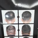 기대만족 안양점 | 안양 두피문신 [디랩스칼프] SMP 2차 후기, 정수리탈모관리 전과 후의 만족스런 변화 ~! 👍🏼