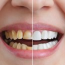 운정퍼스트치과의원 네이버블로그