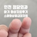 정담외과의원 | 인천 정담외과 아기 화상 치료 후기, 소아 화상 응급 대처법