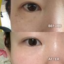 문의제일의원 | 웨딩 관리 추천: 루나의원 루비레이저 내돈내산 후기 (광고 ,보정 X, 잡티 레이저 1~11일)