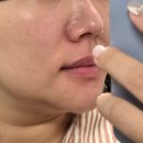 90일의기적의원 | 티타늄 리프팅 1회차 내돈내산 후기