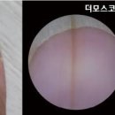 피부 악성 흑색종 증상 및 원인 치료 : 손톱 발톱(엄지) 이미지