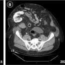 Acquired ectopic kidney 이미지